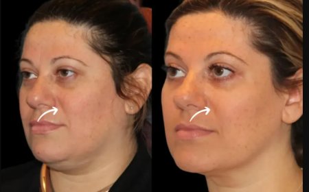 Sculptra Fillers Myths Debunked by Dubai’s Best Aesthetic Clinic