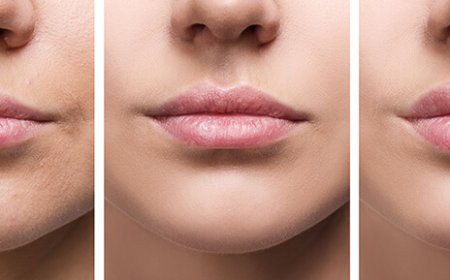 Lip Fillers Dubai: Before and After Care Tips