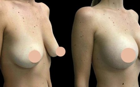Best Breast Augmentation Surgeons in Dubai: How to Ensure a Smooth Recovery After Your Surgery