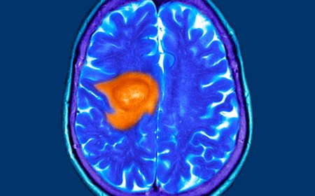 Exploring the Potential of Hyperbaric Oxygen Treatment for Cancer Support