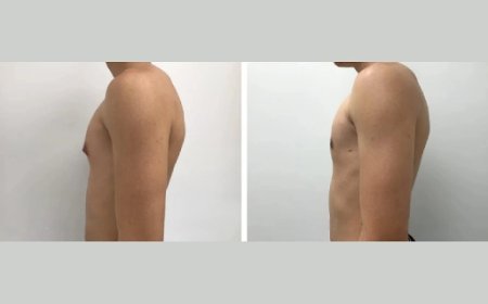 Why You Should Trust the Best Gynecomastia Surgeons in Dubai for Your Male Breast Reduction Surgery