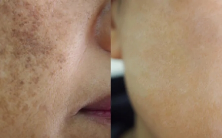 How Pigmentation Treatment Can Help with Sun Damage and Age Spots