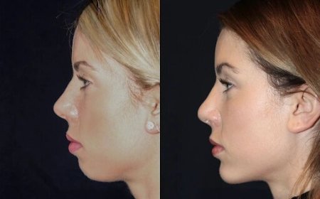 Chin Fillers in Dubai: How They Can Transform Your Appearance