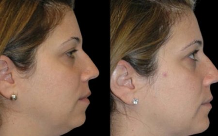 Chin Fat and Confidence: Best Doctors in Dubai on Self-Image