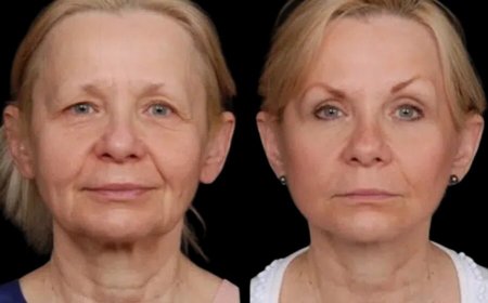 Why Under Eye Fillers Treatment in Dubai is the Best for Brightening Your Eyes