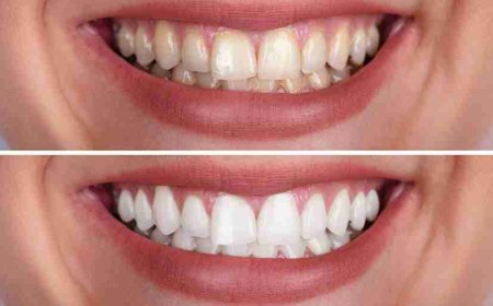 Activated Charcoal vs White Charcoal: Which Whitens Teeth Better?