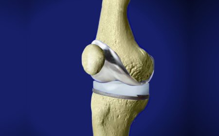 Get Back on Your Feet with a Skilled Joint Replacement Surgeon in Jaipur