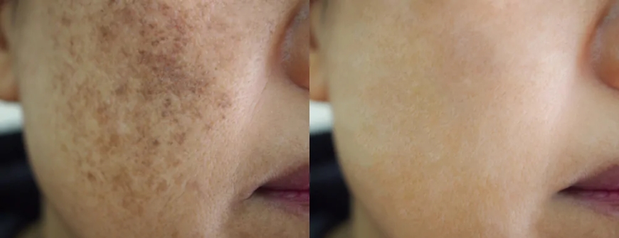 How Pigmentation Treatment Can Help with Sun Damage and Age Spots