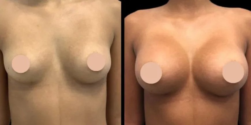 How to Prepare for Breast Augmentation Surgery in Dubai: Tips for a Smooth Procedure