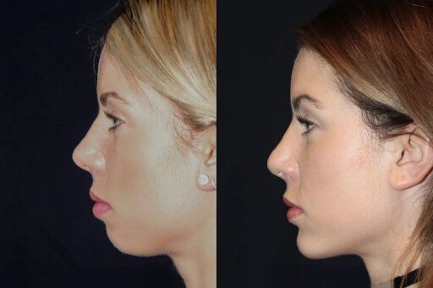 Chin Fillers in Dubai: How They Can Transform Your Appearance
