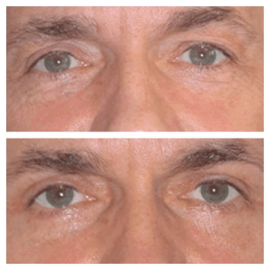 Eye Bag Removal Testimonials Approved by the Best Doctors in Dubai