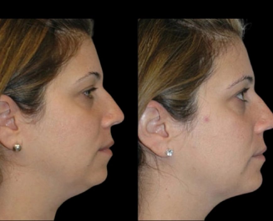 Chin Fat and Confidence: Best Doctors in Dubai on Self-Image