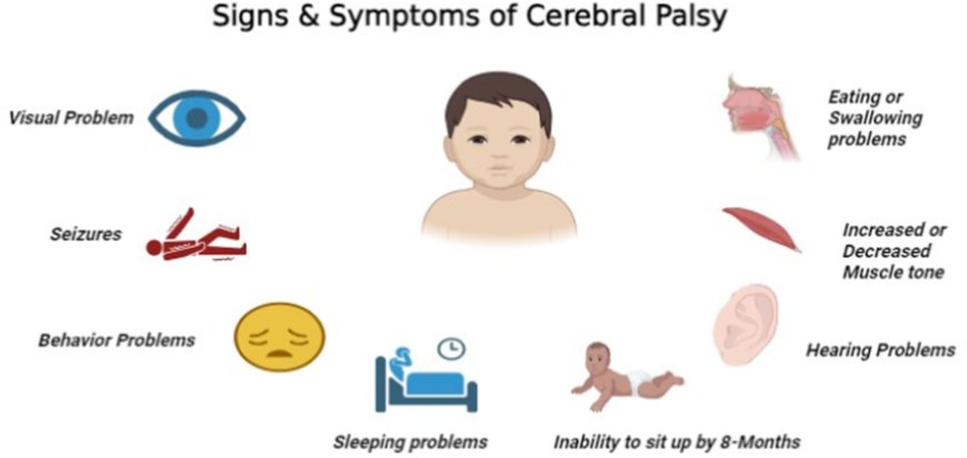 Managing Cerebral Palsy Symptoms with Muscle Relaxant Baclofen